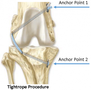 TightropeProcedure